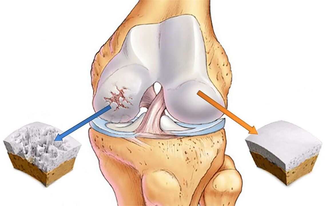 Destruição da cartilagem da articulação do joelho com gonartrose