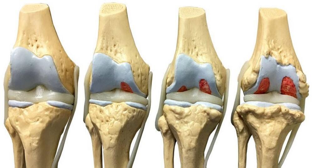 Estágios de desenvolvimento da artrose da articulação do joelho