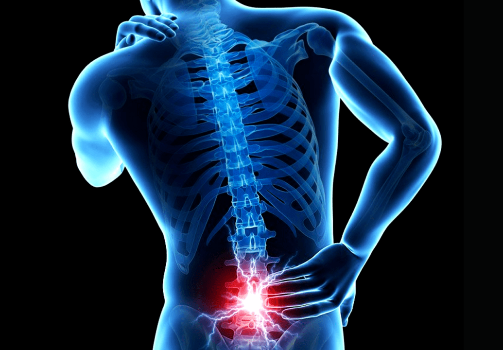 sinais de osteocondrose lombar