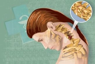Sintomas reflexos de osteocondrose cervical
