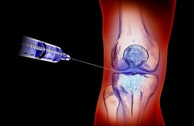 O plano de tratamento para artrose da articulação do joelho