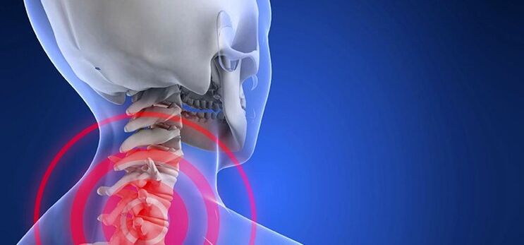 Osteocondrose da coluna cervical