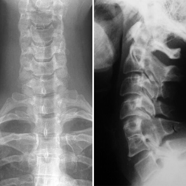 Radiografia da coluna cervical