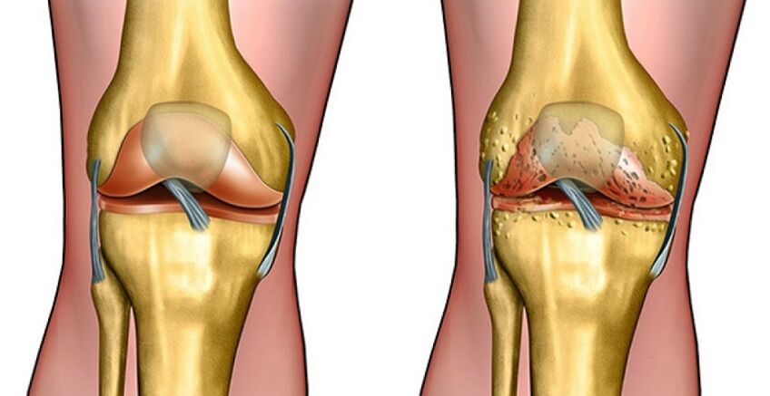 articulação saudável e artrose da articulação do joelho